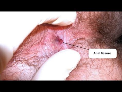 Lift Procedure Anal Fissure Surgery Fistulectomy Surgery Video Rectum Fistula Youtube