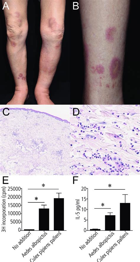 Figure A Edema And Sporadic Annular Erythema On The Patients Thigh