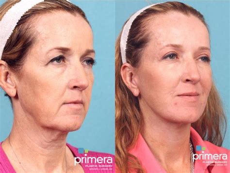 Neck Lift Before And After Pictures Case 496 Orlando Florida