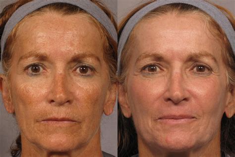Lumenis Co2 Laser Skin Resurfacing At Aesthetic Plastic Surgery And Med
