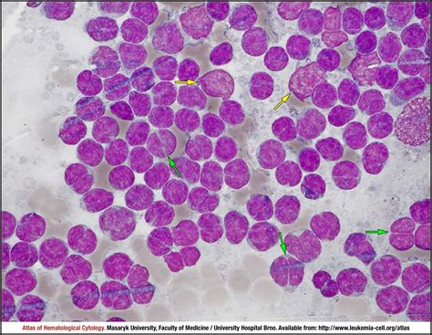 Follicular Lymphoma Cell Atlas Of Haematological Cytology