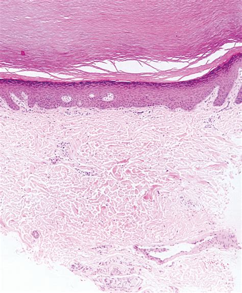 Congenital Hyperkeratotic Papules In A 15 Year Old Girl—quiz Case