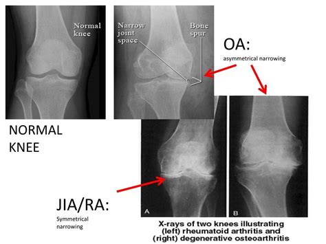 </b> rheumatoid arthritis (ra) is a polyarticular disease with bilateral and symmetric distribution. Image result for osteoarthritis vs rheumatoid arthritis x ...
