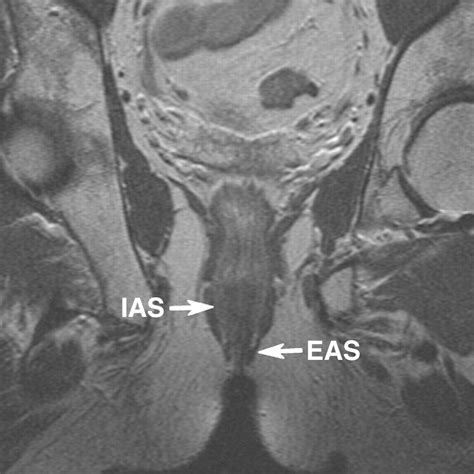 Mri In Evaluating Atrophy Of The External Anal Sphincter In Patients
