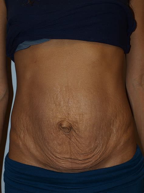 Abdominoplasty Before And After 02 ARC Plastic Surgery