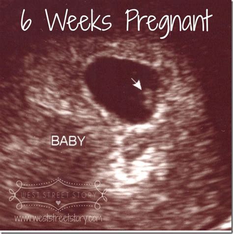 @michellebaltazar0318, your ultrasound says ga 11w2d in the top left corner which means gestational age 11 weeks 2 days! 6 Week Pregnancy Ultrasound | All About Pregnancy ...