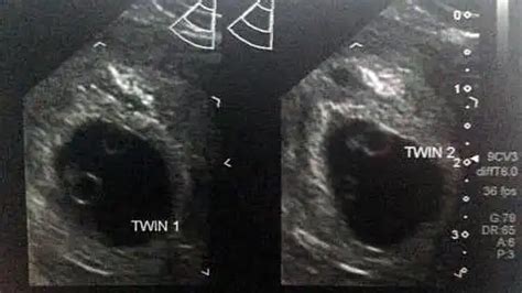 Weeks Pregnant With Twins Belly Pictures Symptoms Ultrasound