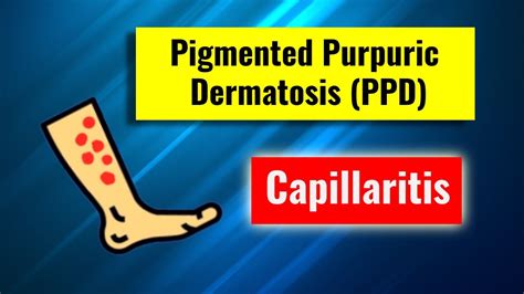 Pigmented Purpuric Dermatosis Capillaritis Overview Clinical