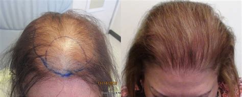 Womens Hair Transplant Before And After Pictures