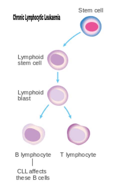 Why Chronic Lymphocytic Leukaemia Is Different From Other Types Of