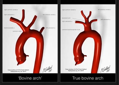 The Most Common Aortic Arch Variants Are The So Called Bovine Arches Bovine Boise State