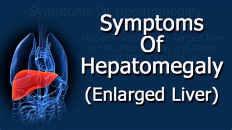 Symptoms Of Hepatomegaly Enlarged Liver Youtube