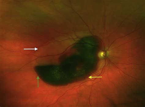 Submacular Hemorrhage In Neovascular Age Related Macular Degeneration