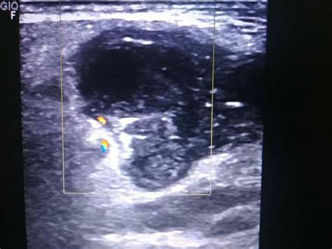 Parotid Abscess Ultrasound Technician Sonography Ultrasound