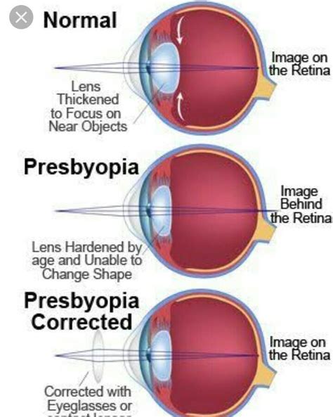 list two causes of presbyopia draw a labelled diagram of a lens used for the correct of this