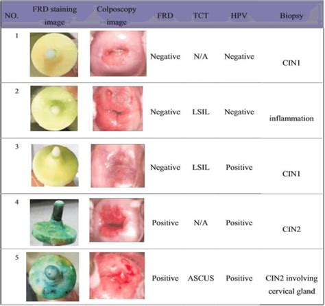 Does A Colposcopy Detect Cervical Cancer ️updated