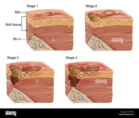 Illustration Showing The 4 Stages Of A Bedsore Or Pressure Sore Bedsores Can Be Caused By Many