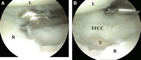 A Suction Biter Debriding A Central Tfcc Tear The Arthroscope Is In Download Scientific