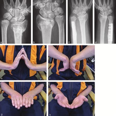 Shortening Of Limb After Fracture Valorant