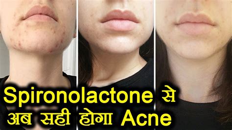 Spironolactone For Acne Spironolactone Can Clear Acne Effectively In