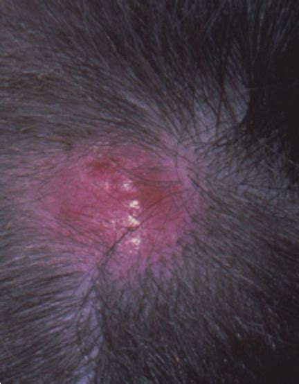 Clinical Appearance Of Lesion At Presentation On The Patients Scalp