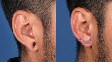 Torn Ear Plastic Surgery Plastic Surgery Gaithersburg Md Plastic