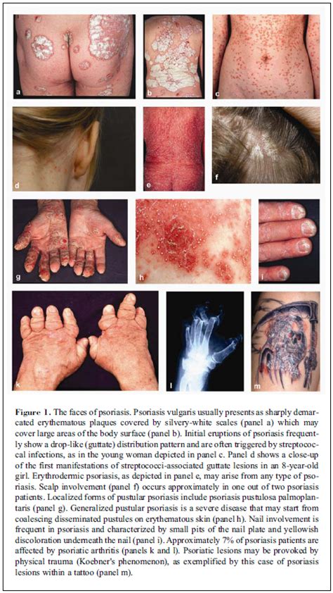 Types Of Psoriasis Pictures Dorothee Padraig South West Skin Health Care