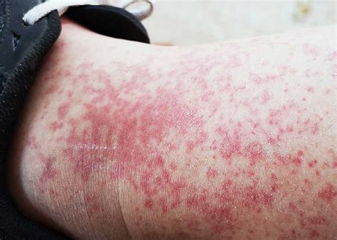 Lichen Planus Causes Treatment Dermatology Inc