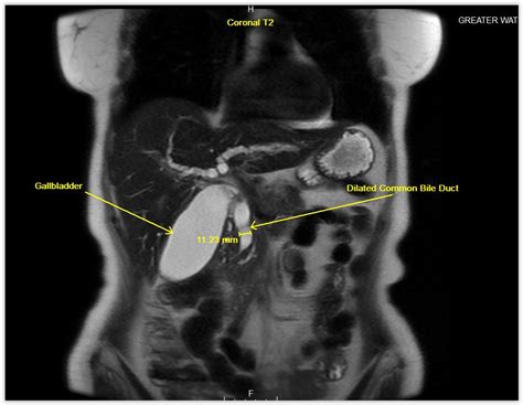 Radiology Anatomy Images Mrcp Radiology Anatomy