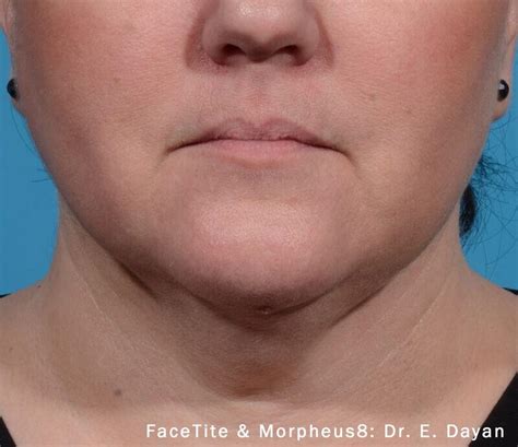 Before And After Facetite Novi Center For Facial Plastic Surgery