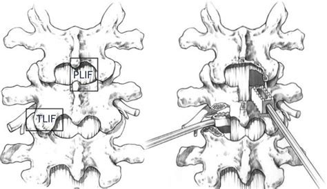 Transforaminal Lumbar Interbody Fusion Tlif Ars Neurochirurgica
