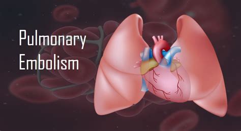 Learn about what exactly a pulmonary embolism is and what to. I don't know what to write my paper about Warfarin blood ...