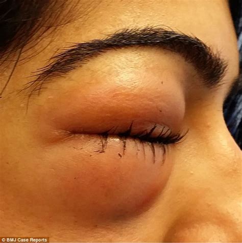 Womans Eye Swelled To The Size Of A Golf Ball After She Forcefully