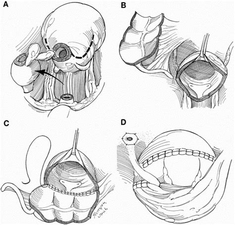 A Technique Of Bladder Neck Closure Combining Prostatectomy And Intestinal Interposition For