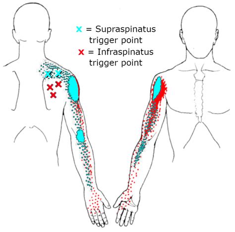 Shoulder Pain Radiating Down Arm To Fingers And How To Relieve It