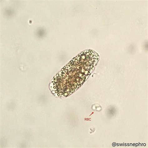 Lipid Cast In A Patient With Significant Proteinuria Bright Field