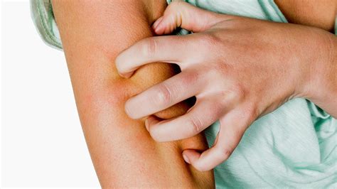 Dermatitis atópica así es la segunda enfermedad más diagnosticada de