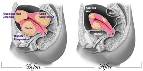 UAE After A Traditional Surgical Procedure Fibroid Treatment For The