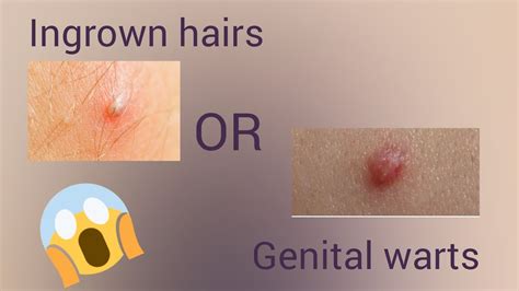 Ingrown Hair Vs Genital Warts