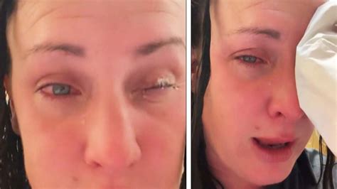 Woman Recounts Mistaking Nail Glue For Eye Drops And Gluing Eye Shut Inside Edition