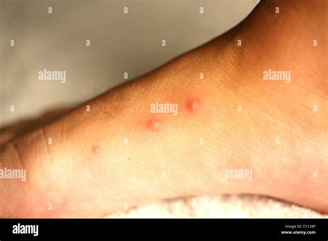 Bed Bug Bites High Resolution Stock Photography And Images Alamy
