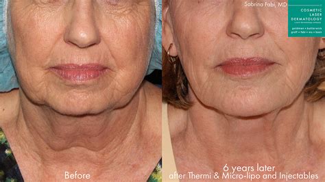 Ultherapy Skin Tightening Med Spa San Diego Ca Clderm