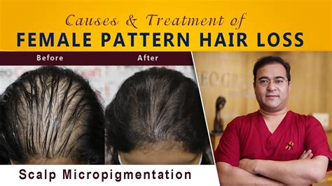 Female Pattern Hair Loss Causes And Treatment In 10 Minutes Youtube