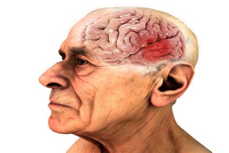 What Is Alzheimers Disease Symptoms Causes Diagnosis Types Stages Lifeexpectancy