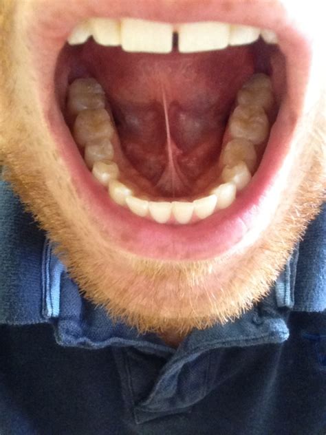 Bumps On Floor Of Mouththread Discussing Bumps On Floor
