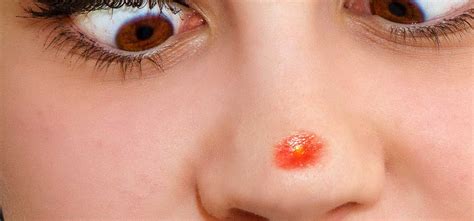 Pimples on the nose, near the nose and inside the nose! Why you shouldn't pop your pimples. Really, you shouldn't