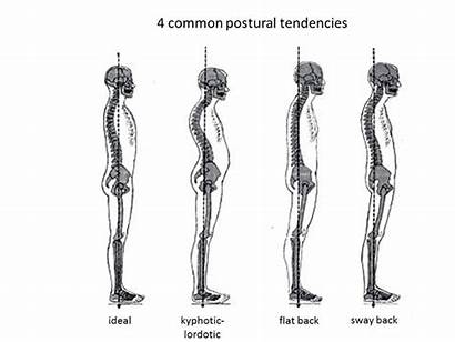 Posture Pain Sway Flat Kyphotic Exercises Lordotic