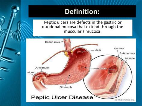 Peptic Ulcer Disease By Dr Sookun Rajeev Kumar Md