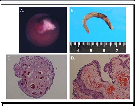 Figure 2 From A Case Of Fibroepithelial Polyp In Right Lower Ureter