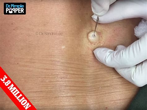 Dr Pimple Popper Claims Gruesome Viral Videos Make Her
